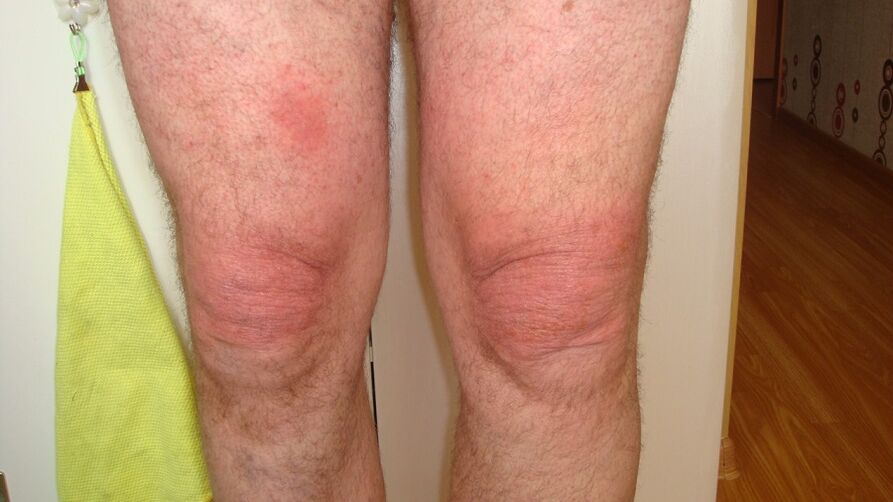 αρθρώσεις των αρθρώσεων γόνατος